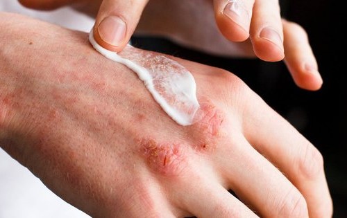 Có thể dùng thuốc chống viêm, chống dị ứng như kem có corticoid khi da mới nổi các mẩn đỏ nhỏ