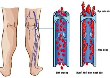 Huyết khối tĩnh mạch sâu gây ứ trệ tuần hoàn dẫn đến đau nhức chân