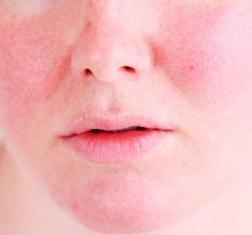 Kích ứng viêm da có các biểu hiện thường như bỏng, mặt nóng rát, đau ngứa, sưng đỏ và có thể xuất hiện mụn.