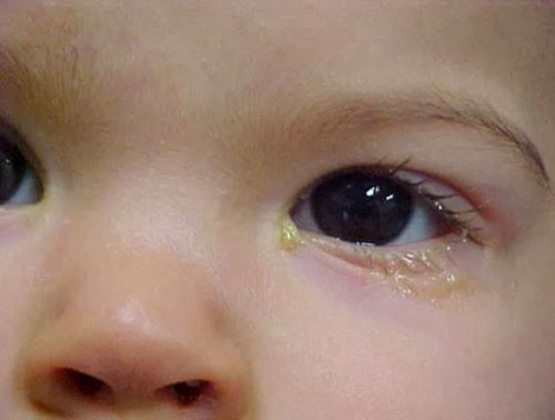 Trẻ hay bị chảy gỉ mắt là một dấu hiệu nhận biết tắc lệ đạo